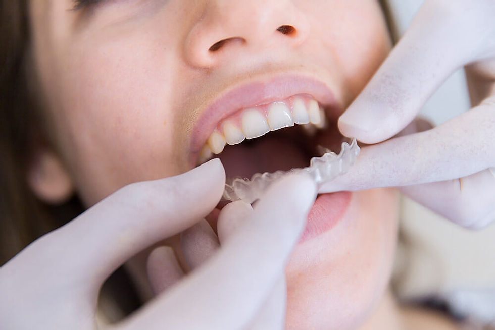 dentista colocando um alinhador ortodôntico invisível no paciente.