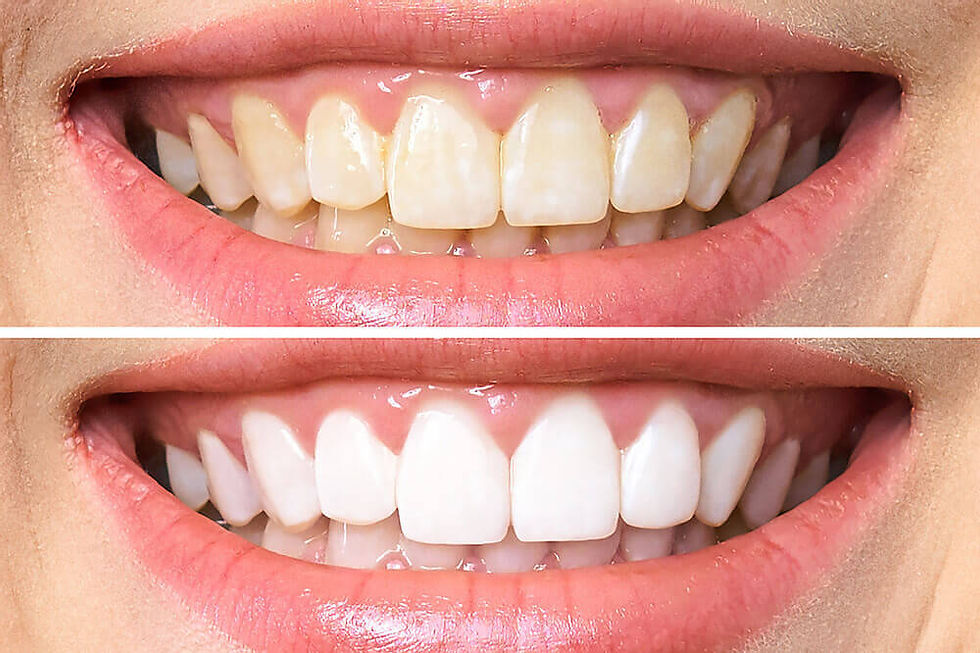 imagens do antes e depois de um clareamento dos dentes