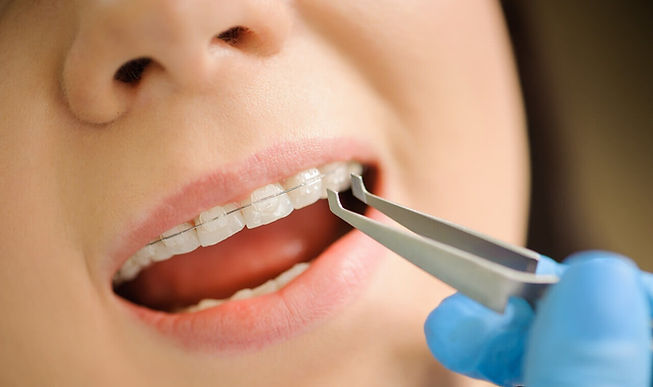 braquetes cerâmicos em close-up nos dentes da paciente